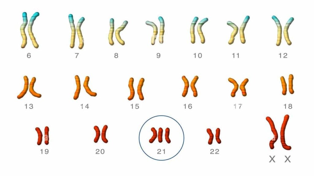 Trisomie 21 : des chercheurs parviennent à éliminer le chromosome en trop