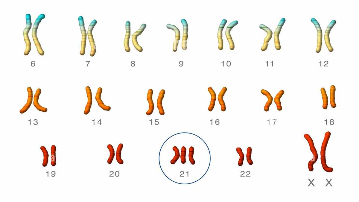 Trisomie 21 : des chercheurs parviennent à éliminer le chromosome en trop